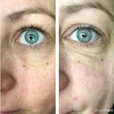 I Love My Eye Arise It Tightens Skin Reduces The Appearance Of Wrinkles And Fine Lines And Shrinks Puffy Under Eye Wrinkles Cystic Acne Treatment Eye Wrinkle