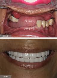 The implant is made of medical grade titanium. Full Mouth Dental Implants All On 6 Dental Implants Implant Dentist Nyc