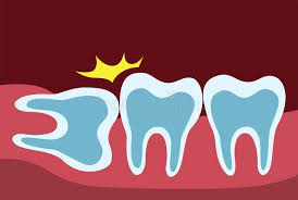 In the story, the big bad wolf threatens to destroy the hard work of the pigs. Wisdom Teeth Stock Illustrations 1 464 Wisdom Teeth Stock Illustrations Vectors Clipart Dreamstime