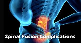 Instead, during the surgery a bone graft. Spinal Fusion Complications