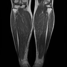 The intrinsic foot muscles comprise four layers of small muscles that have both their origin and insertion attachments within the foot foot muscles mri. Plantaris Tendon Rupture Radiology Case Radiopaedia Org