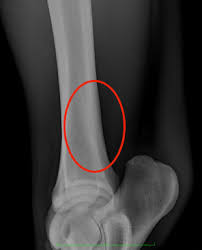 Image result for Tibia Stress Fracture