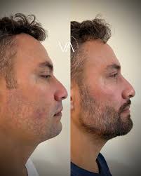 Olha esse resultado maravilhoso! ✨🤎 Fizemos uma avaliação detalhada e  identificamos os pontos ideais para harmonizar e destacar ainda mais a  beleza natural. O resultado? Um rosto mais equilibrado e rejuvenescido, sem