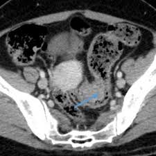 The symptoms of endometriosis include painful periods, painful ovulation, pain during or after sexual intercourse, heavy bleeding, chronic pelvic pain, fatigue, and infertility. Sigmoid Colon Endometriosis Mimicking Sigmoid Colon Carcinoma With Extra Serosal Involvement Eurorad