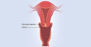 Image result for Cervical Cancer