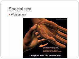 Image result for Scaphoid Shift Test