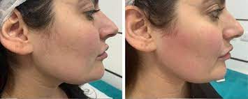 Facial hair removal for women over 50 the do's 1. Arashigaoka Hvala Ti Junacki Laser Hair Removal Face Mgglobalsoftinc Com