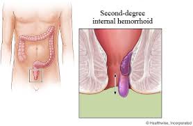 Image result for hemoroid human
