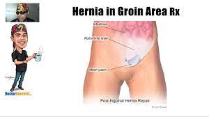 It searches for specific sites so it may i have several in my inner thighs, near my groin. Hernia In Groin Area Secrets Boing Youtube