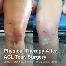 What Does Physical Therapy After A Major Acl Surgery Look Like Brittany Tore Her Acl And Had To Un Acl Surgery Recovery Acl Surgery Acl Reconstruction Surgery