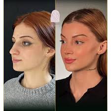 Neck lift Prices & Packages 2025