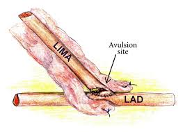 It is a paired artery, with one running along each side of the sternum, to continue after its bifurcation as the superior epigastric and musculophrenic arteries. Figure 1 Perioperative Avulsion Of A Left Internal Mammary Artery Graft In A Patient With Syphilis