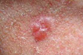 The ultraviolet radiation or uv rays given off by the sun can mutate skin cells and turn them cancerous. Skin Cancer Parknorthdermatology