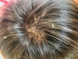 Apply on hair and massage the scalp. Garlic For Hair Growth Review Does It Work Updated For 2021