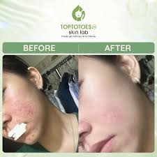 ĐẨY NHANH LIỀN SẸO, TRẺ HÓA TỔNG THỂ LÀN DA VỚI LIỆU TRÌNH TẠI TOPTOTOESVN  Trong gần 10 đồng hành điều trị da cùng các bạn, nhà Top nhận thấy việc điều