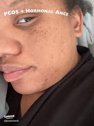 My Experience with Cult Coconut Yogurt: A Game-Changer for PCOS and Gut  Health