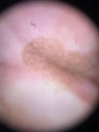 Image result for Macule