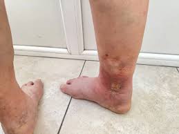 Image result for Pigment stains on the shin