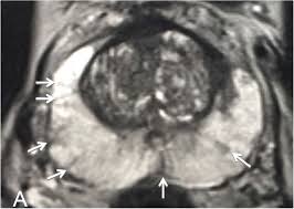 Prostate cancer is a common type of cancer in men, according to the mayo clinic. Peripheral Zone Enlargement A Newly Described Entity On Mri Medrxiv