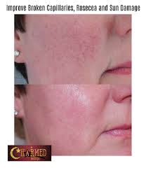 Broken capillaries on chest treatment. Broken Capillaries Redness And Rosecea Dramatically Improved Charmed Medispa
