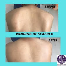 Image result for Winged Scapula