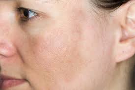 I took a trip over to schweiger dermatology group in nyc and asked for a uv photo of my skin. Sun Damaged Skin Causes And Effect Arsenault Dermatology