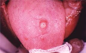 Image result for syphilis ulcer