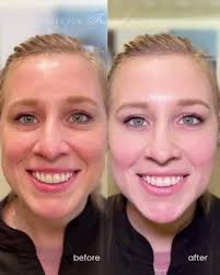 ✨ Subtle Enhancements, Stunning Results! ✨, Our gorgeous client, a mother  of two in her thirties, wanted a little refresh—nothing dramatic, just a  touch of volume in all the right places. And wow, ...