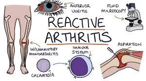 We did not find results for: Reactive Arthritis Zero To Finals