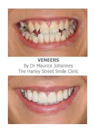 We did not find results for: Veneers For Crooked Teeth Harley Street Smile Clinic