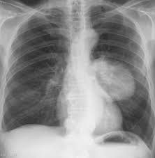 Image result for lung cancer xray