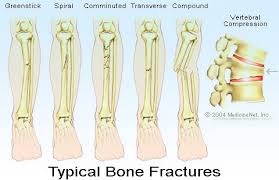 Fractures Bone Fracture Fractures Fracture Symptoms