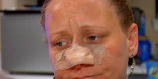 Woman speaks out after nose bitten off in violent attack