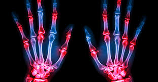 Resultado de imagem para artrite reumatoide