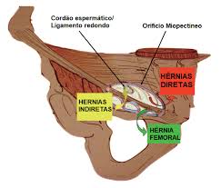 Clinica Factum Cirurgia Do Aparelho Digestivo Hernias Da Parede Abdominal