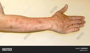 Image result for Photodermatitis