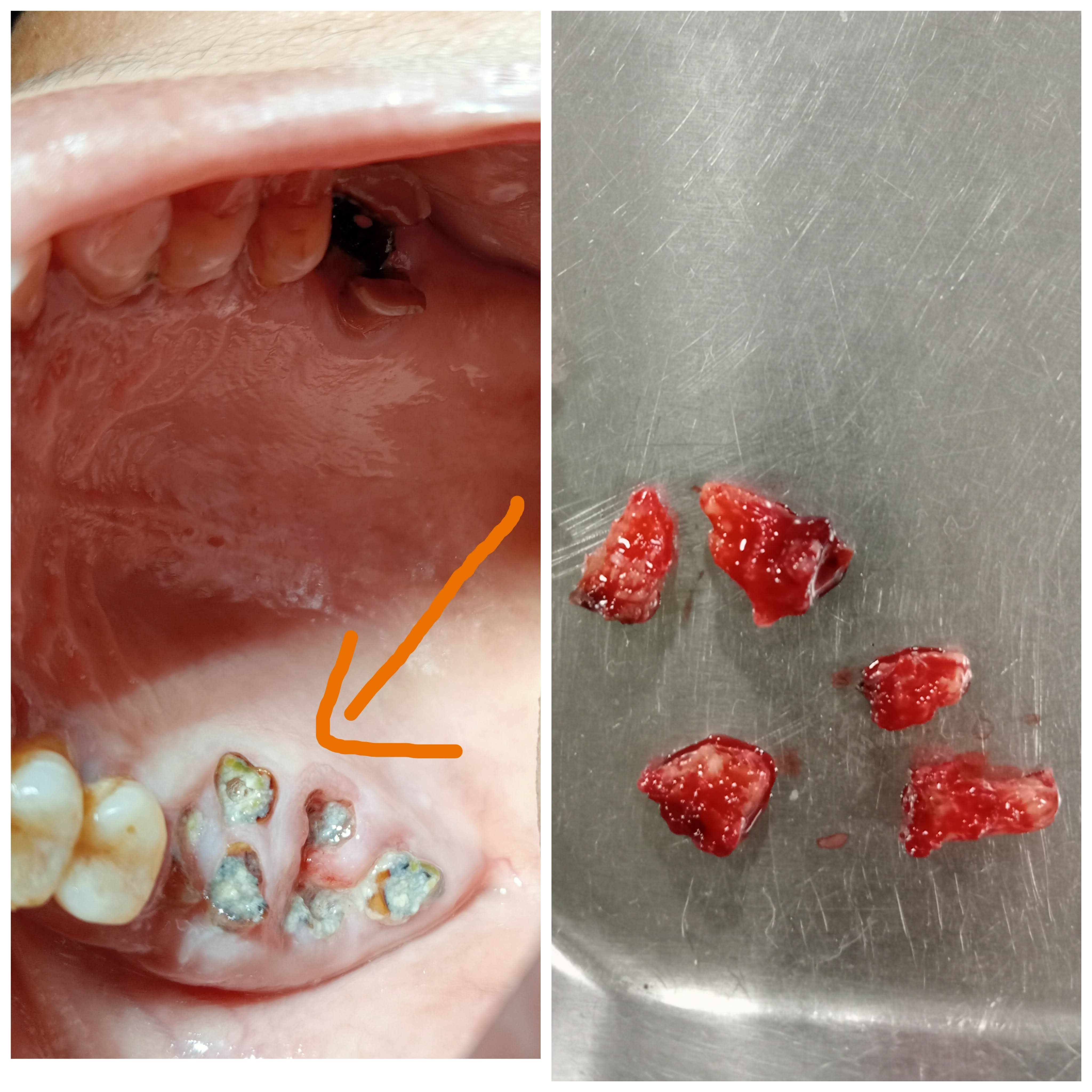 Minor oral surgery.