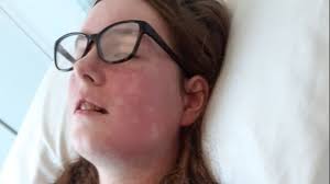 Yate woman in hospital six years after holiday mosquito bite