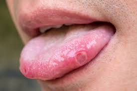 Image result for Canker sores roof of mouth
