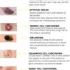 Merkel cell carcinoma is most common on the face, neck, arms, and legs. 1