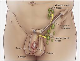 Certain cancers can also lead to swollen lymph nodes. Recent Advances In The Management Of Penile Cancer A Contemporary Review Of The Literature Springerlink