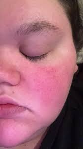 My eyes guys are red like so red 😭 what can I use for my eyes to be white  🥺?