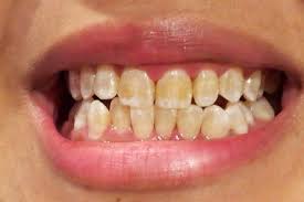 Come Sbiancare I Denti In 3 Minuti Con La Curcuma Sbiancare I Denti Consigli Di Bellezza Casalinghi Pulire I Denti