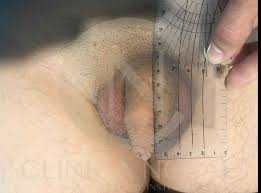 Antes y Después de Alargamiento de Pene - Casos Reales | CN Medical