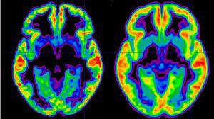 Psychosis refers to a set of symptoms characterized by a loss of touch with reality due to a disruption in the way that the brain processes information. Schizophrenie Definition Symptome Ursachen Behandlung
