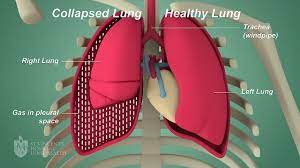 A collapsed lung is rare, but it can be serious. Pneumothorax St Vincent S Lung Health