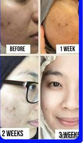 Ingin cepat menghilangkan jerawat tapi takut dan mahal? Set Jeragat Shaklee Pengedar Shaklee Shah Alam