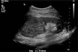 Recurrent Urinary Tract Infections In An Adult With A Duplicated Renal Collecting System Sciencedirect