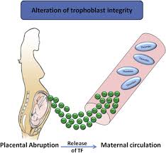 Image result for ISTH DIC Score
