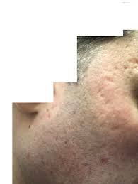 Check spelling or type a new query. Someone Please Advise On Scar Scar Treatments Acne Org